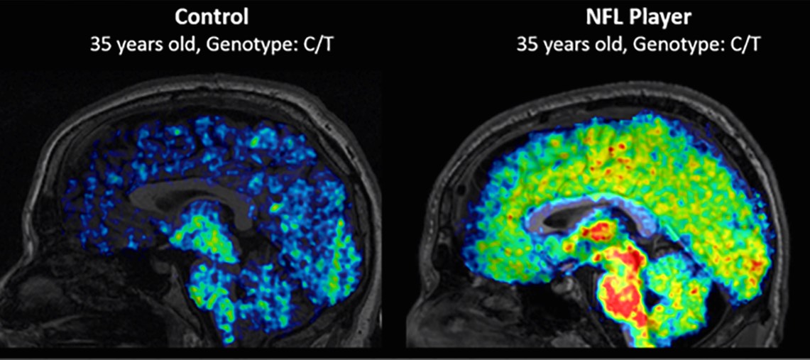 TSPO in brains